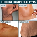 nuvadermis-clear-silicone-scar-tape-for--4.jpg